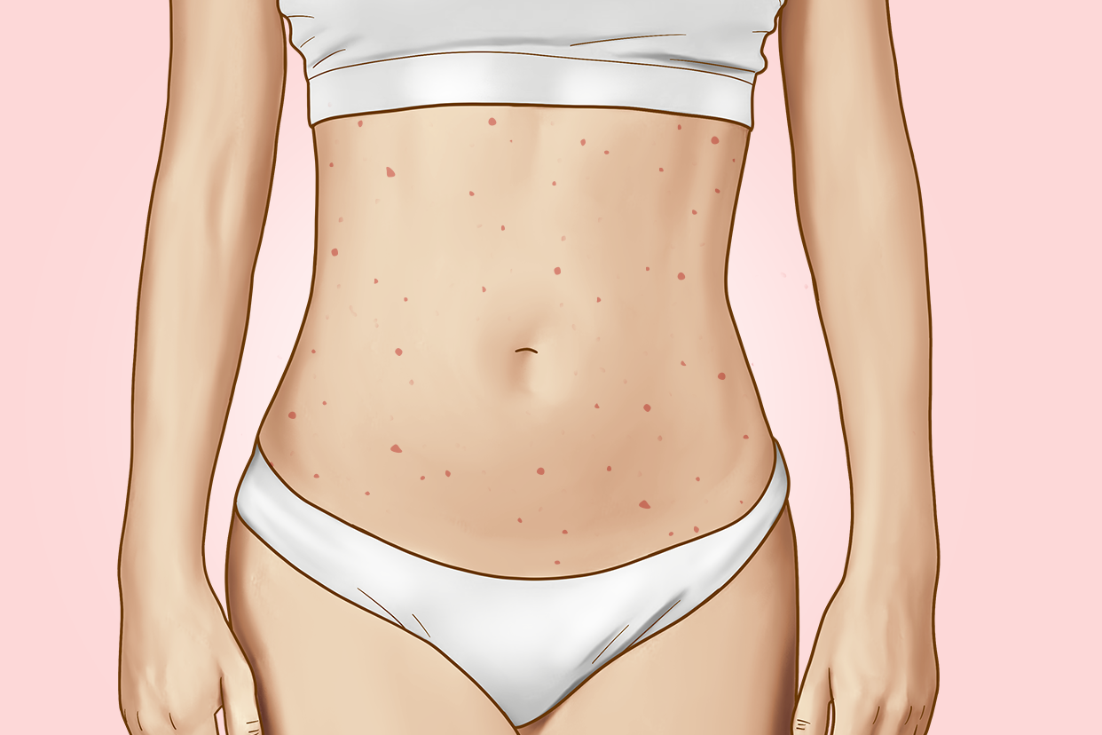 各种痣的图片介绍 痣相图解大全:好痣坏痣