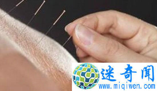 女子做针灸扎破肺做针灸竟被扎破肺 小命差点不保