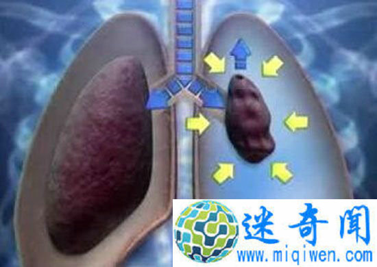 女子做针灸扎破肺做针灸竟被扎破肺 小命差点不保