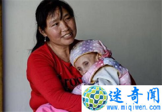 12岁拇指姑娘患病仅重20斤