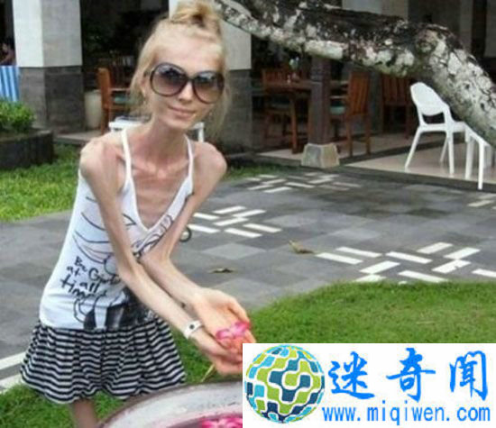 全球最瘦的女人仅20公斤!令人侧目的世界之最