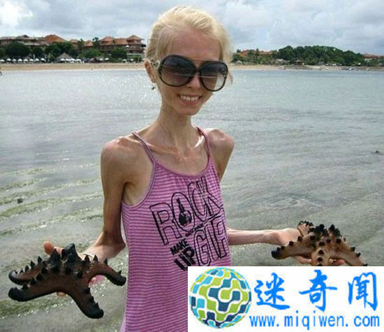 全球最瘦的女人仅20公斤!令人侧目的世界之最